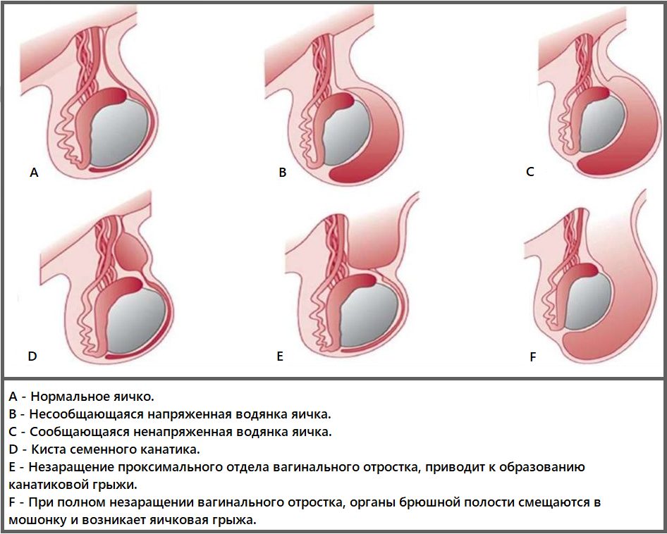 Гидроцеле (водянка яичка): 6 признаков, которые стоит знать