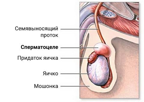 Киста яичка и киста придатка: что делать, если нашли образование